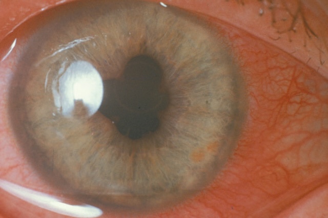 Synéchies iridocristalliniennes visibles avec pupille déformée et hyperhémie, évoquant une séquelle inflammatoire intraoculaire.