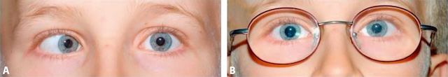 Photographies cliniques montrant un strabisme accommodatif corrigé par une prescription optique complète.