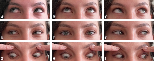 Séquence de photos évaluant les mouvements oculaires. Analyse de la coordination des muscles responsables de la mobilité des deux yeux.