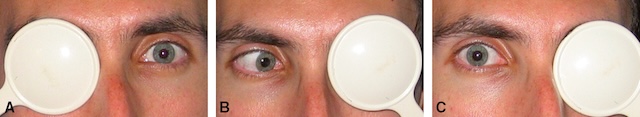 Série de photos montrant un cover-test révélant une paralysie du VI droit, caractérisée par une déviation de l’œil vers le nez lors de l’occlusion controlatérale.