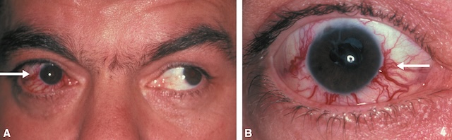 Exophtalmie gauche avec œil rouge congestif et limitation motrice, signes typiques d’une fistule carotidocaverneuse responsable de diplopie.