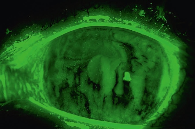 Fluorescéine montrant kératopathie ponctuée épithéliale. Sécheresse oculaire sévère avec altérations diffuses de la surface cornéenne.