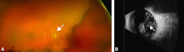Hémorragie intravitréenne visible en fond d’œil (A) et en échographie (B), avec opacification partielle du vitré sans décollement rétinien associé.