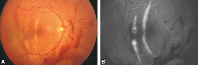 Rupture choroïdienne atteignant la macula avec hyperfluorescence angiographique centrale, responsable d’une baisse d’acuité visuelle définitive.