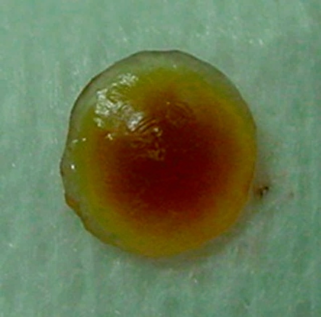 Cristallin extrait montrant une opacification brun-jaunâtre du noyau, typique d’une cataracte nucléaire évoluée.