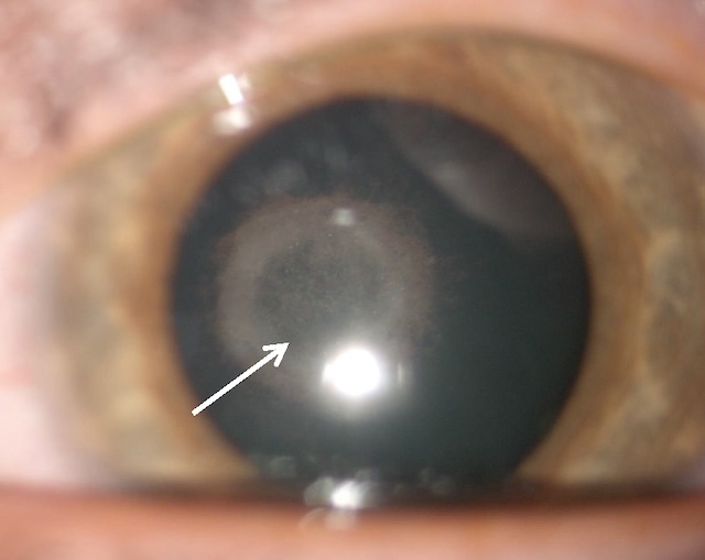 Opacification en soucoupe à l’arrière du cristallin, caractéristique d’une cataracte sous-capsulaire postérieure, gênant fortement la vision.