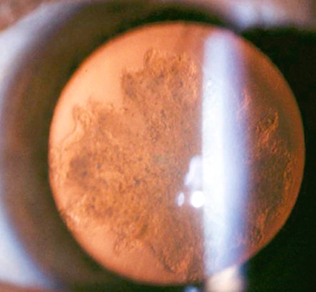 Opacité postérieure du cristallin en aspect étoilé, révélée par rétro-illumination, typique d’une cataracte sous-capsulaire postérieure.