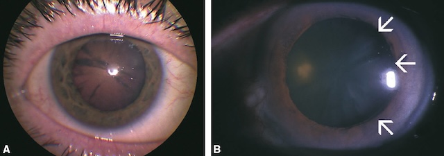 Opacités radiaires du cristallin en forme de cavaliers, caractéristiques d’une cataracte corticale visible en éclairage direct et à la lampe à fente.
