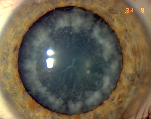 L’image montre un œil humain avec des cataractes. La cornée est opacifiée au centre. L’iris présente des motifs complexes, entouré par une sclère blanche, nette et visible.