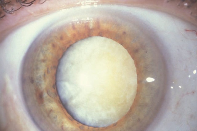 L’image montre un œil atteint d’une cataracte totale, avec une pupille voilée et blanchâtre. L’iris et la sclère restent visibles, offrant un contraste net.