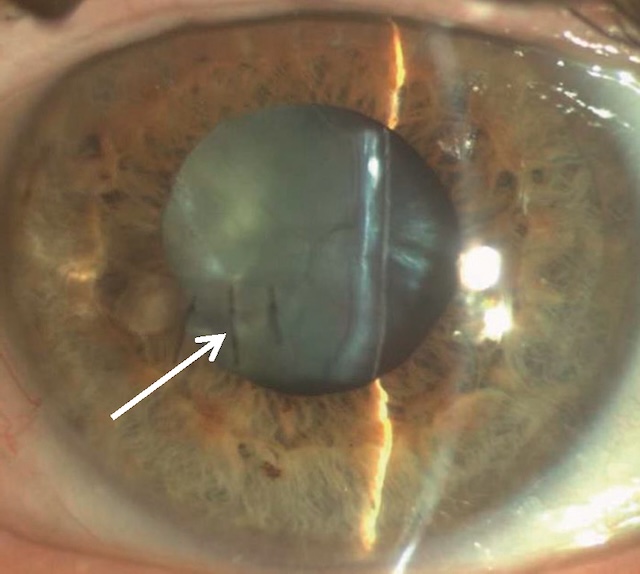 Aspect de cataracte traumatique centrale avec suture cornéenne inférieure visible, secondaire à un traumatisme perforant bien cicatrisé.