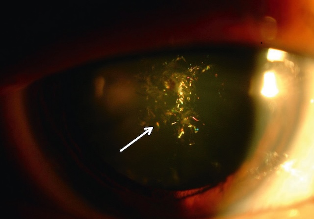 Opacités cristalliniennes centrales multicolores en étoile, typiques d'une cataracte polychrome chez un patient atteint de dystrophie de Steinert.