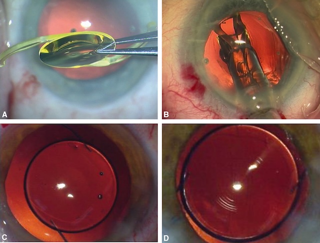 Série illustrant les étapes clés de l’implantation d’une lentille intraoculaire après chirurgie de la cataracte, avec un positionnement final stable.