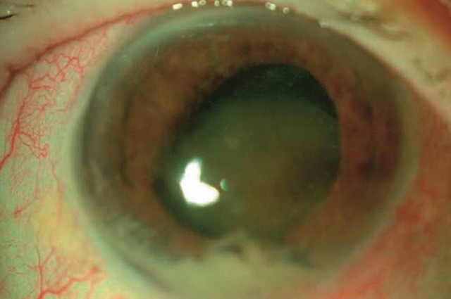 Medium,Cataracte hypermature compliquée d’un pseudo-hypopion inflammatoire dans un contexte d’uvéite phacoantigénique sévère.