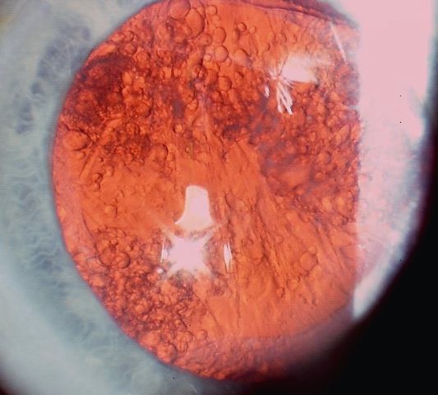 Medium,Aspect typique d’opacification capsulaire postérieure avec perles d’Elschnig et fibrose après chirurgie de cataracte.