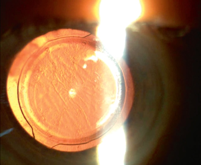 Capsule postérieure fibreuse avec stries denses, altérant l’axe visuel et entraînant une baisse visuelle progressive après chirurgie de la cataracte.