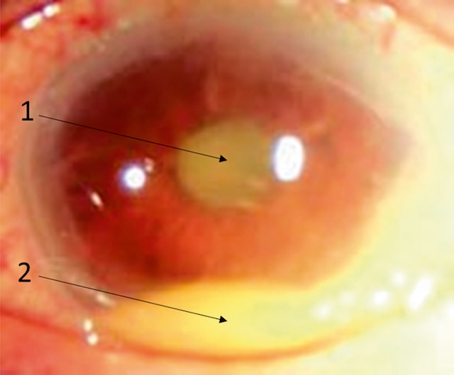 Fibrine pupillaire centrale (1) et hypopion déclive (2) caractéristiques d’une endophtalmie avec inflammation intraoculaire intense.