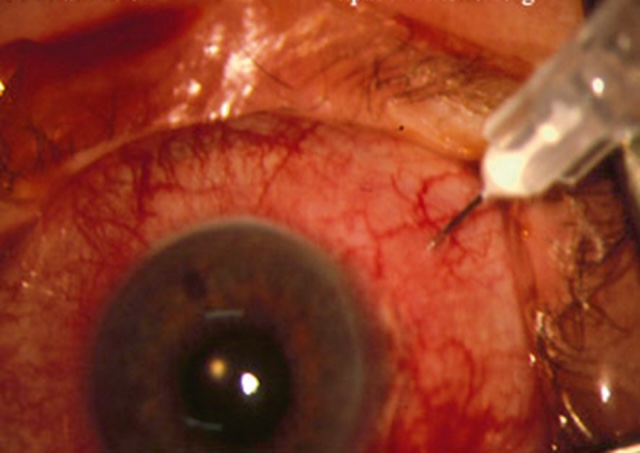 Injection sous-conjonctivale visible dans un œil inflammatoire postopératoire, avec diffusion de médicament sous la conjonctive en zone temporale supérieure.