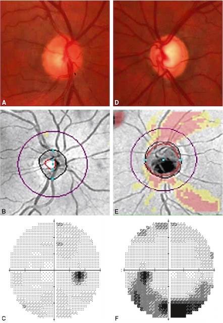 Comparaison de deux nerfs optiques avec excavation glaucomateuse et altération du champ visuel droite, évoquant un glaucome unilatéral évolué.